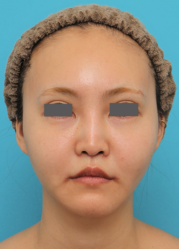 鼻の下を短く（上口唇短縮手術、上口唇リフト、リップリフト、人中短縮術）,人中短縮+口角挙上+小鼻縮小を行った30代女性症例写真,3週間後,mainpic_hanashita009d.jpg