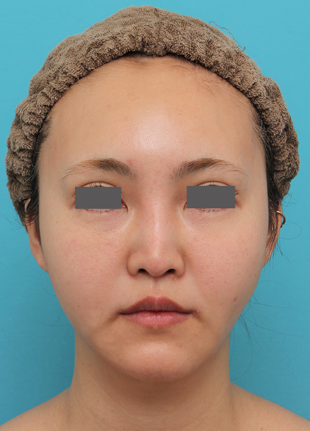 鼻の下を短く（上口唇短縮手術、上口唇リフト、リップリフト、人中短縮術）,人中短縮+口角挙上+小鼻縮小を行った30代女性症例写真,2ヶ月後,mainpic_hanashita009e.jpg
