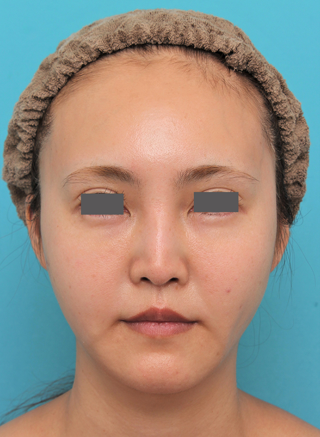 鼻の下を短く（上口唇短縮手術、上口唇リフト、リップリフト、人中短縮術）,人中短縮+口角挙上+小鼻縮小を行った30代女性症例写真,6ヶ月後,mainpic_hanashita009f.jpg