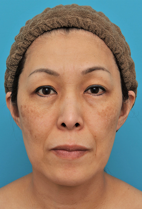 ミディアムフェイスリフト,ミディアムフェイスリフトを行った50代女性の症例写真,Before,ba_mediumlift022_b01.jpg