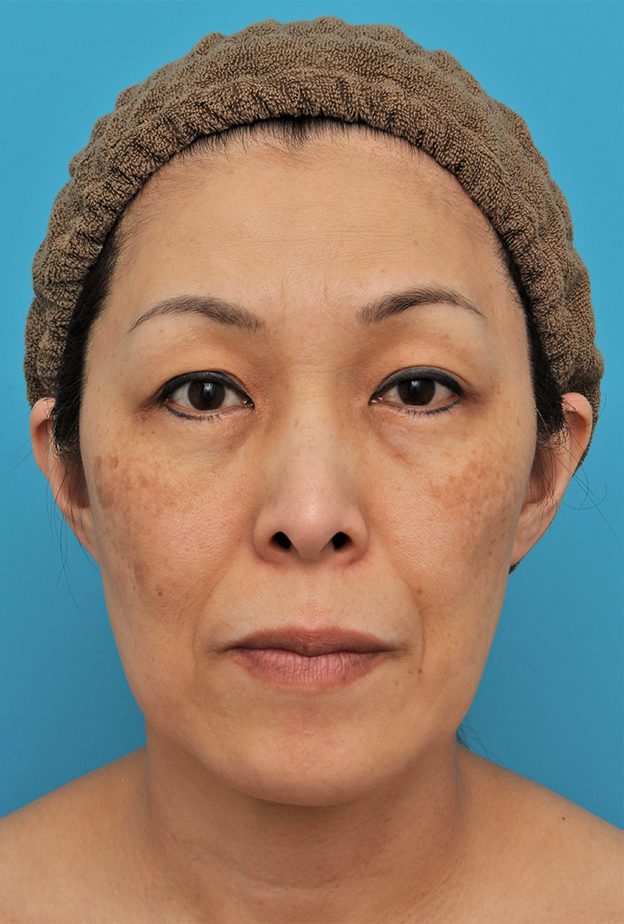 ミディアムフェイスリフト,ミディアムフェイスリフトを行った50代女性の症例写真,手術前,mainpic_mediumlift022a.jpg
