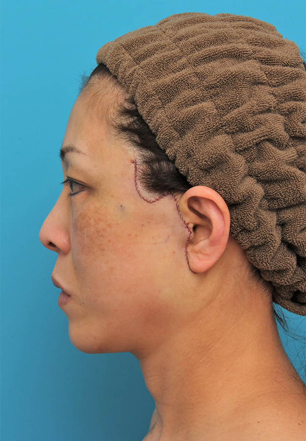 ミディアムフェイスリフト,ミディアムフェイスリフトを行った50代女性の症例写真,手術直後,mainpic_mediumlift022g.jpg