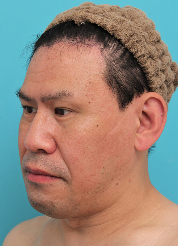 額リフト（額のしわ取り手術）,額の切開リフトを行った40代男性の症例写真,After（6ヶ月後）,ba_hitailift004_b02.jpg