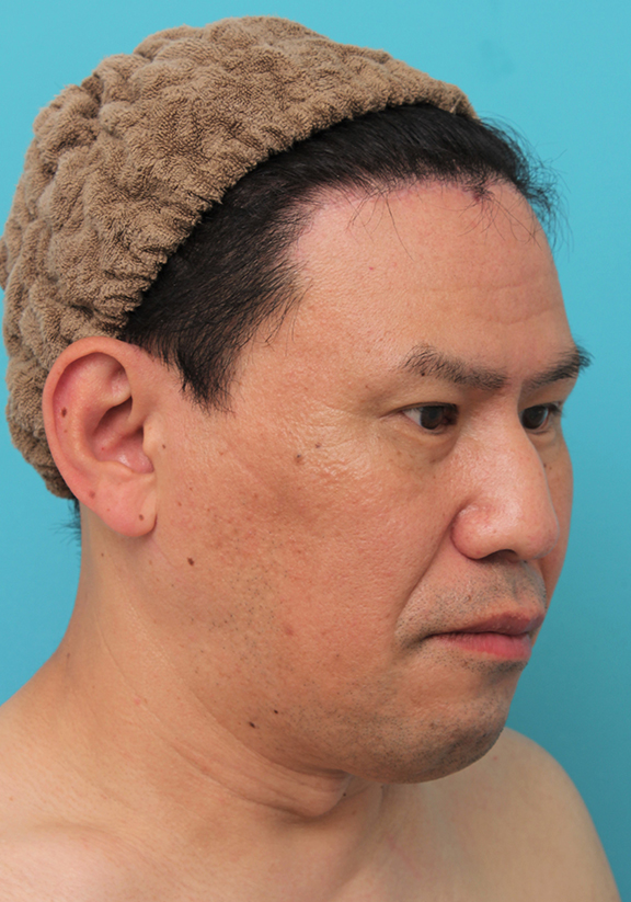 額リフト（額のしわ取り手術）,額の切開リフトを行った40代男性の症例写真,After（6ヶ月後）,ba_hitailift004_b03.jpg