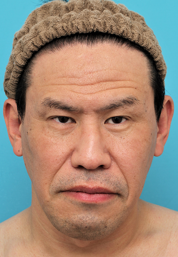 額リフト（額のしわ取り手術）,額の切開リフトを行った40代男性の症例写真,Before,ba_hitailift004_b01.jpg