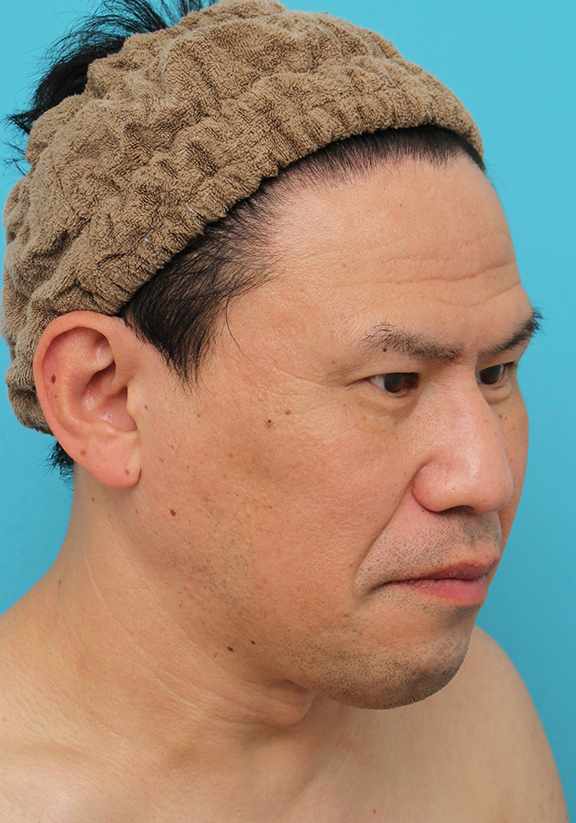 額リフト（額のしわ取り手術）,額の切開リフトを行った40代男性の症例写真,Before,ba_hitailift004_b03.jpg