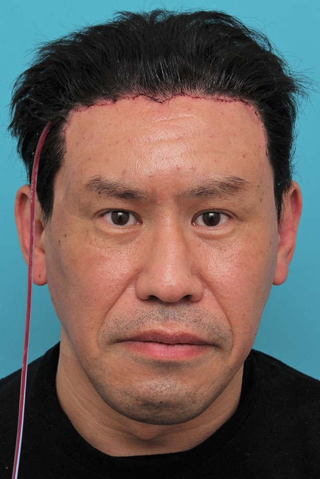 症例写真,額の切開リフトを行った40代男性の症例写真,手術翌日,mainpic_hitailift004c.jpg