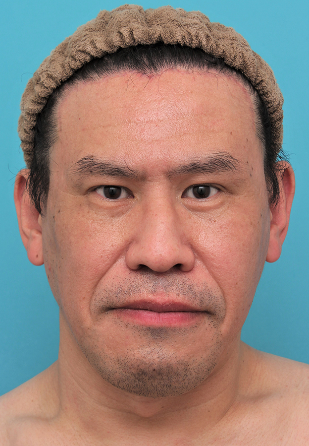 額リフト（額のしわ取り手術）,額の切開リフトを行った40代男性の症例写真,2ヶ月後,mainpic_hitailift004f.jpg