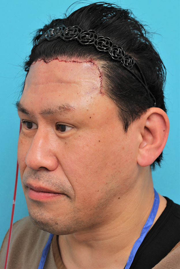 額リフト（額のしわ取り手術）,額の切開リフトを行った40代男性の症例写真,手術直後,mainpic_hitailift004i.jpg