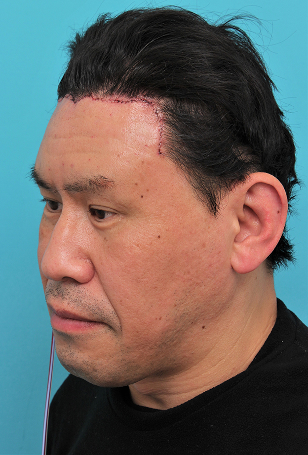 額リフト（額のしわ取り手術）,額の切開リフトを行った40代男性の症例写真,手術翌日,mainpic_hitailift004j.jpg