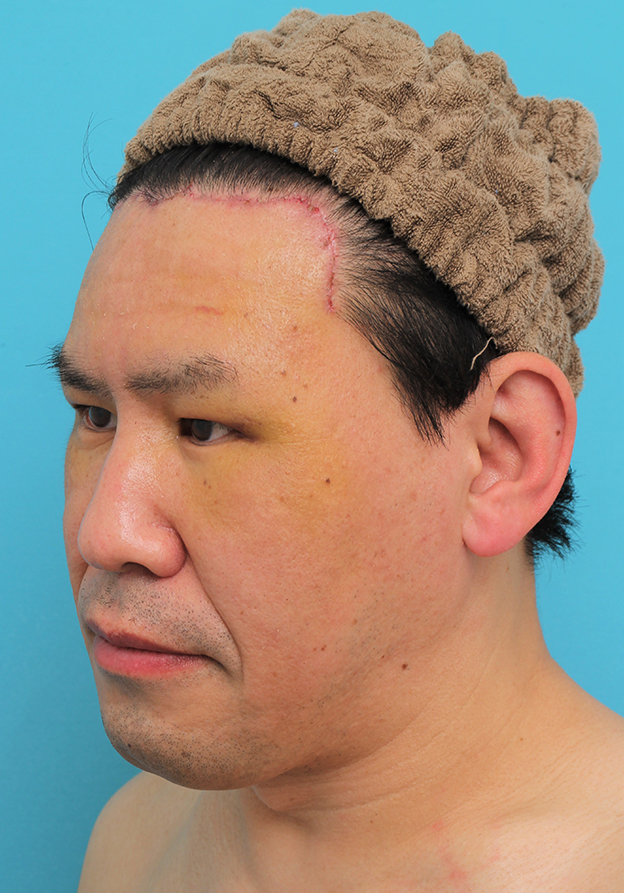 額リフト（額のしわ取り手術）,額の切開リフトを行った40代男性の症例写真,1週間後,mainpic_hitailift004k.jpg