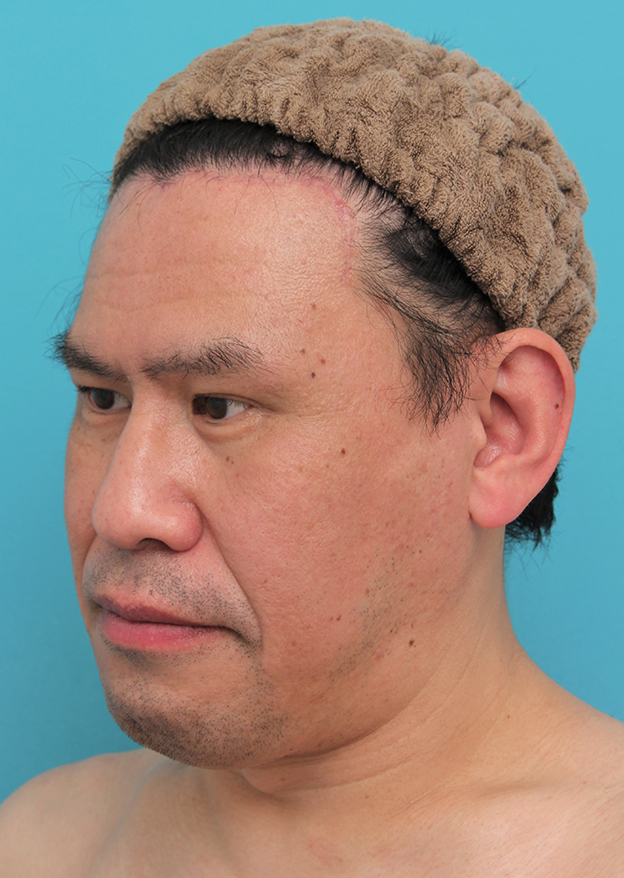 額リフト（額のしわ取り手術）,額の切開リフトを行った40代男性の症例写真,2ヶ月後,mainpic_hitailift004m.jpg