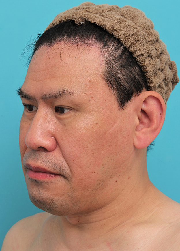 額リフト（額のしわ取り手術）,額の切開リフトを行った40代男性の症例写真,6ヶ月後,mainpic_hitailift004n.jpg