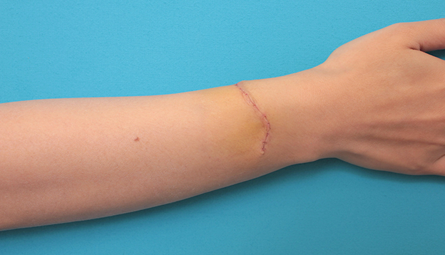 症例写真,根性焼きの傷跡を手術で切除縫合し1本の傷にした症例写真,1週間後,mainpic_wrist002c.jpg