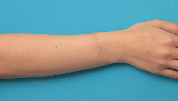 リストカット・根性焼き,根性焼きの傷跡を手術で切除縫合し1本の傷にした症例写真,3週間後,mainpic_wrist002d.jpg