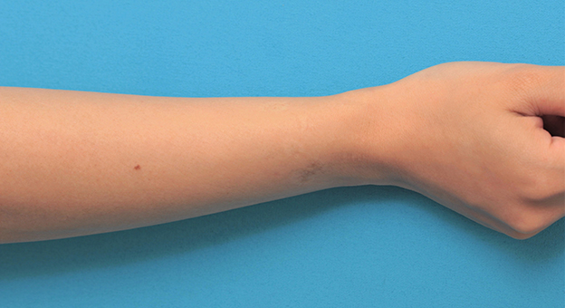 リストカット・根性焼き,根性焼きの傷跡を手術で切除縫合し1本の傷にした症例写真,手術前,mainpic_wrist002h.jpg