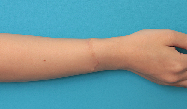 リストカット・根性焼き,根性焼きの傷跡を手術で切除縫合し1本の傷にした症例写真,3週間後,mainpic_wrist002k.jpg