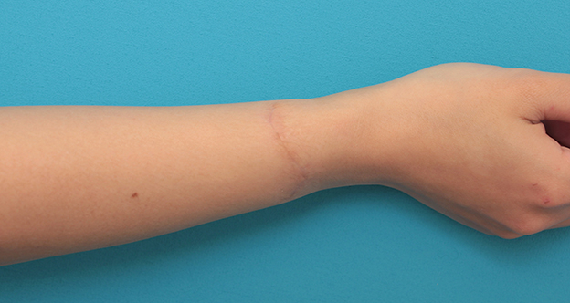 症例写真,根性焼きの傷跡を手術で切除縫合し1本の傷にした症例写真,3ヶ月後,mainpic_wrist002l.jpg