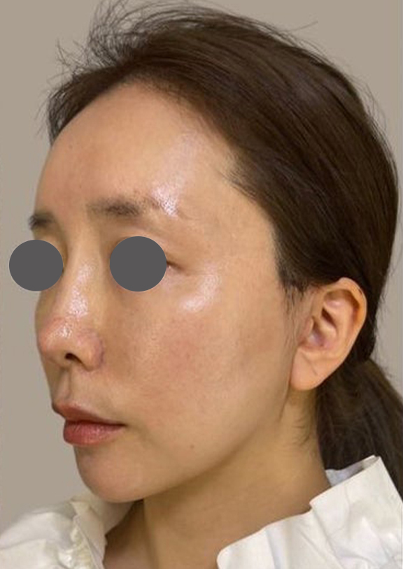 ミニフェイスリフト（頬のたるみ取り）,30代のたるみの少ない方のミニフェイスリフトの症例写真,After（1ヶ月後）,ba_minilift015_a01.jpg