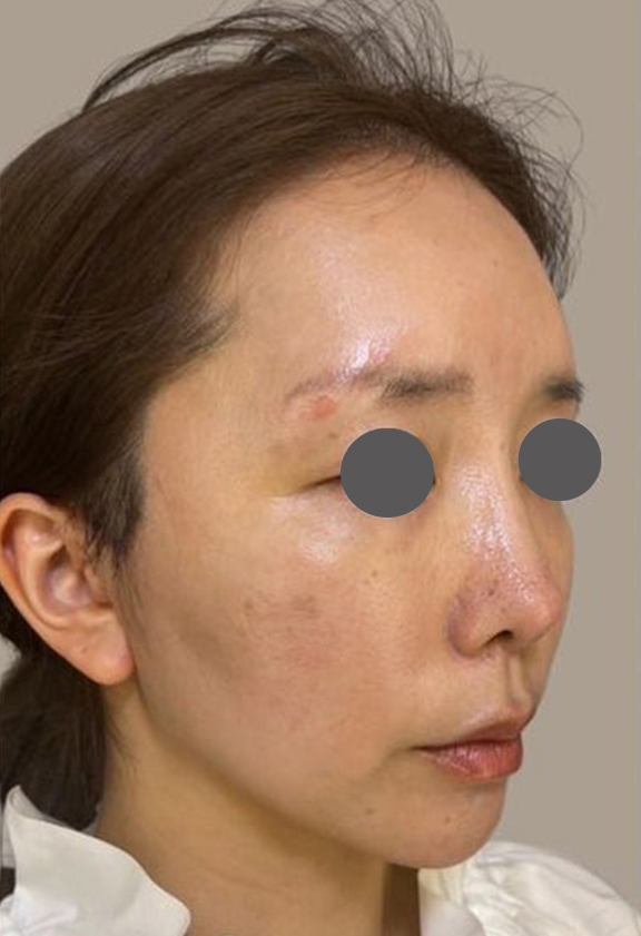 ミニフェイスリフト（頬のたるみ取り）,30代のたるみの少ない方のミニフェイスリフトの症例写真,After（1ヶ月後）,ba_minilift015_b02.jpg