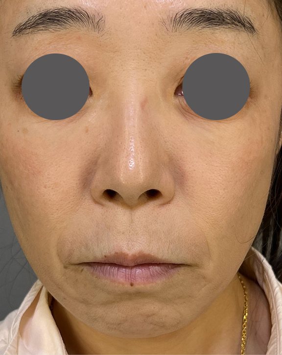 鼻の下を短く（上口唇短縮手術、上口唇リフト、リップリフト、人中短縮術）,鼻の下の余分な皮膚を切除する人中短縮術を行った症例写真,Before,ba_hanashita010_b01.jpg