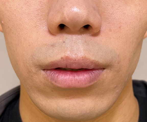 唇を薄く（口唇縮小術）,上下口唇縮小術を行って唇をスッキリとさせた男性の症例写真,After（1ヶ月後）,ba_usuku019_b01.jpg