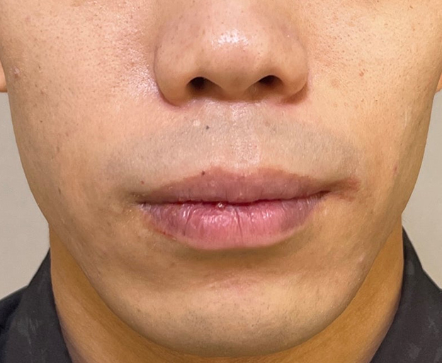 症例写真,上下口唇縮小術を行って唇をスッキリとさせた男性の症例写真,1週間後,mainpic_usuku019b.jpg