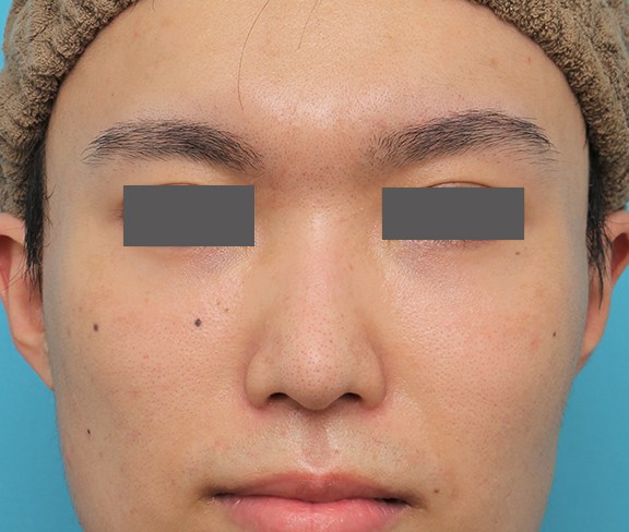鼻翼縮小（小鼻縮小）,小鼻縮小手術を行った20代男性の症例写真,After（6ヶ月後）,ba_biyoku054_a01.jpg