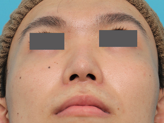 鼻翼縮小（小鼻縮小）,小鼻縮小手術を行った20代男性の症例写真,After（6ヶ月後）,ba_biyoku054_b02.jpg