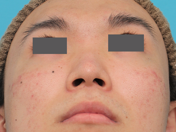 鼻翼縮小（小鼻縮小）,小鼻縮小手術を行った20代男性の症例写真,Before,ba_biyoku054_b02.jpg