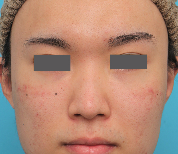 鼻翼縮小（小鼻縮小）,小鼻縮小手術を行った20代男性の症例写真,手術前,mainpic_biyoku054a.jpg