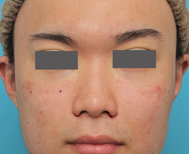 鼻翼縮小（小鼻縮小）,小鼻縮小手術を行った20代男性の症例写真,手術直後,mainpic_biyoku054b.jpg