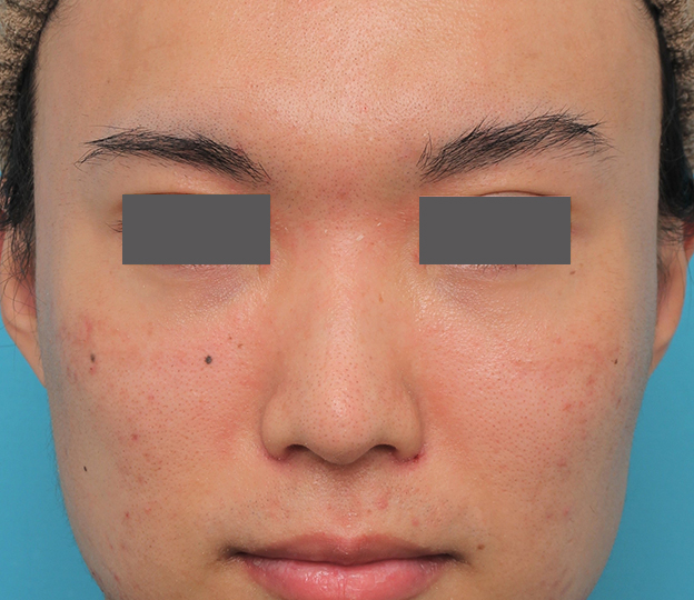 鼻翼縮小（小鼻縮小）,小鼻縮小手術を行った20代男性の症例写真,6日後,mainpic_biyoku054c.jpg
