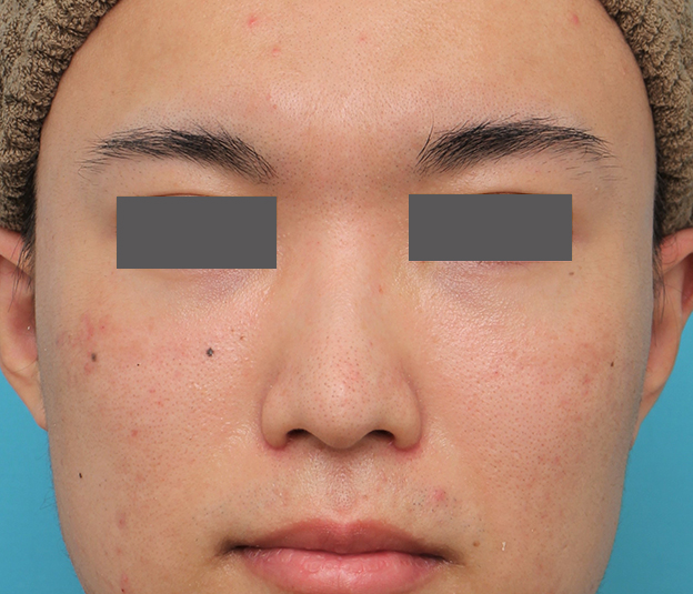 鼻翼縮小（小鼻縮小）,小鼻縮小手術を行った20代男性の症例写真,3週間後,mainpic_biyoku054d.jpg