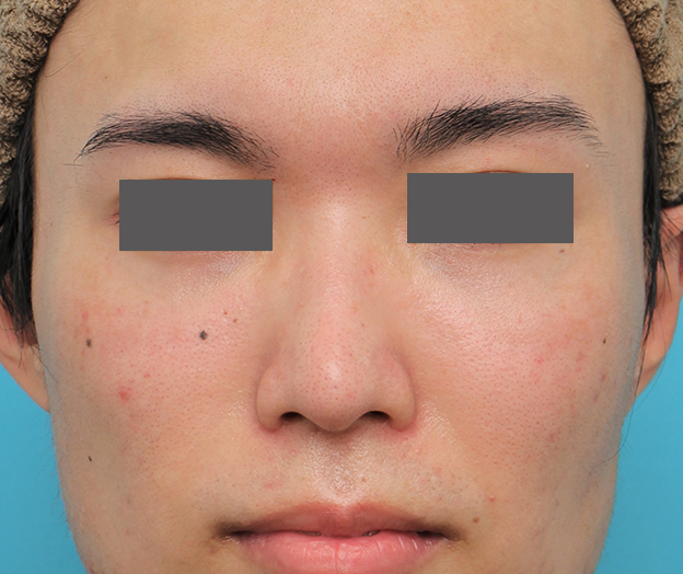 鼻翼縮小（小鼻縮小）,小鼻縮小手術を行った20代男性の症例写真,2ヶ月後,mainpic_biyoku054e.jpg