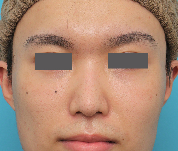 鼻翼縮小（小鼻縮小）,小鼻縮小手術を行った20代男性の症例写真,6ヶ月後,mainpic_biyoku054f.jpg