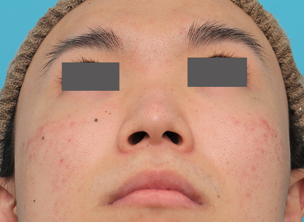 鼻翼縮小（小鼻縮小）,小鼻縮小手術を行った20代男性の症例写真,手術前,mainpic_biyoku054g.jpg