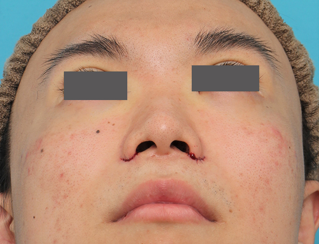 鼻翼縮小（小鼻縮小）,小鼻縮小手術を行った20代男性の症例写真,手術直後,mainpic_biyoku054h.jpg