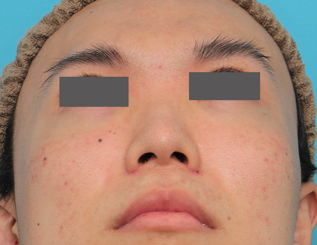 鼻翼縮小（小鼻縮小）,小鼻縮小手術を行った20代男性の症例写真,6日後,mainpic_biyoku054i.jpg