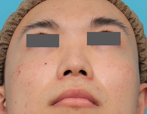 鼻翼縮小（小鼻縮小）,小鼻縮小手術を行った20代男性の症例写真,3週間後,mainpic_biyoku054j.jpg
