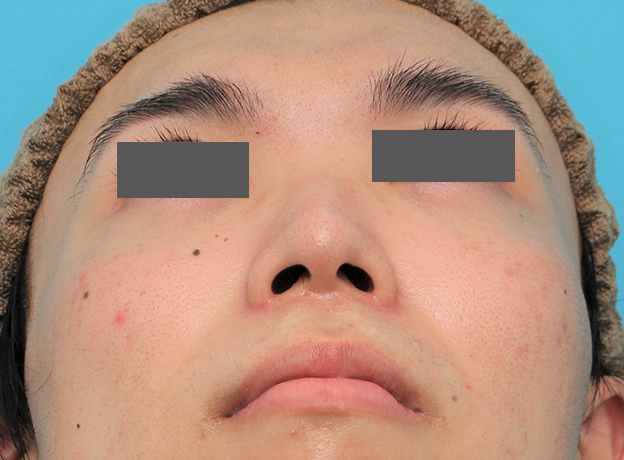 鼻翼縮小（小鼻縮小）,小鼻縮小手術を行った20代男性の症例写真,2ヶ月後,mainpic_biyoku054k.jpg