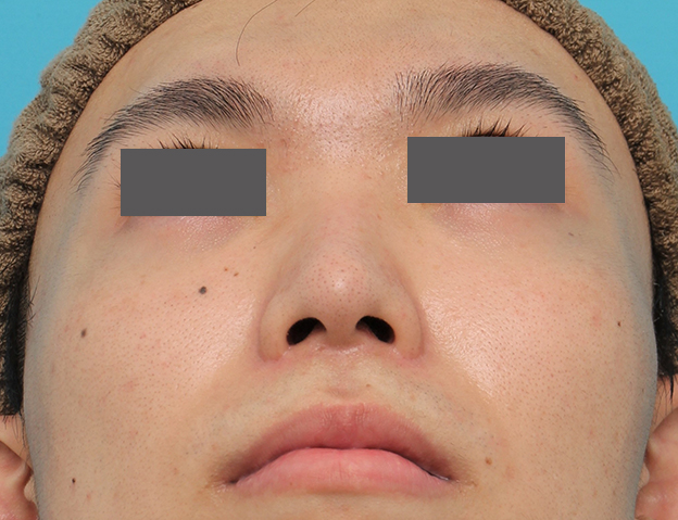 鼻翼縮小（小鼻縮小）,小鼻縮小手術を行った20代男性の症例写真,6ヶ月後,mainpic_biyoku054m.jpg