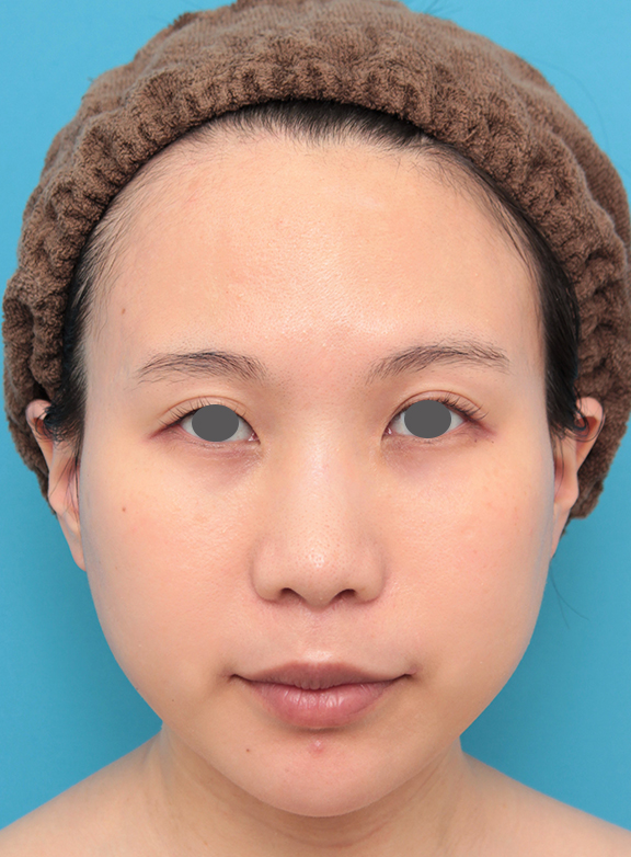 鼻の下を短く（上口唇短縮手術、上口唇リフト、リップリフト、人中短縮術）,口角拳上術,人中短縮と口角挙上を同時に行った20代女性の症例写真,After（6ヶ月後）,ba_hanashita011_a01.jpg