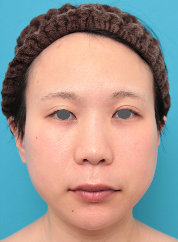 鼻の下を短く（上口唇短縮手術、上口唇リフト、リップリフト、人中短縮術）,口角拳上術,人中短縮と口角挙上を同時に行った20代女性の症例写真,Before,ba_hanashita011_b01.jpg