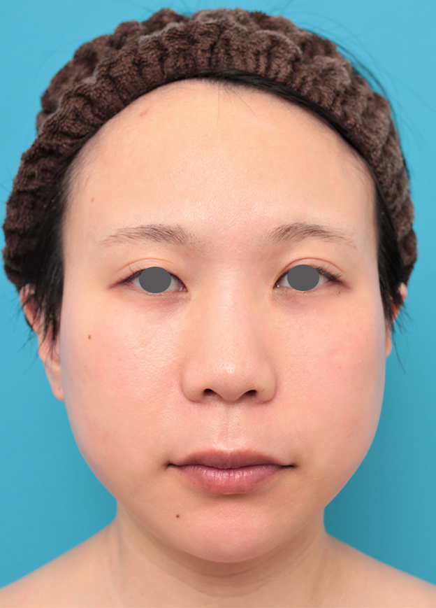 症例写真,人中短縮と口角挙上を同時に行った20代女性の症例写真,手術前,mainpic_hanashita011a.jpg