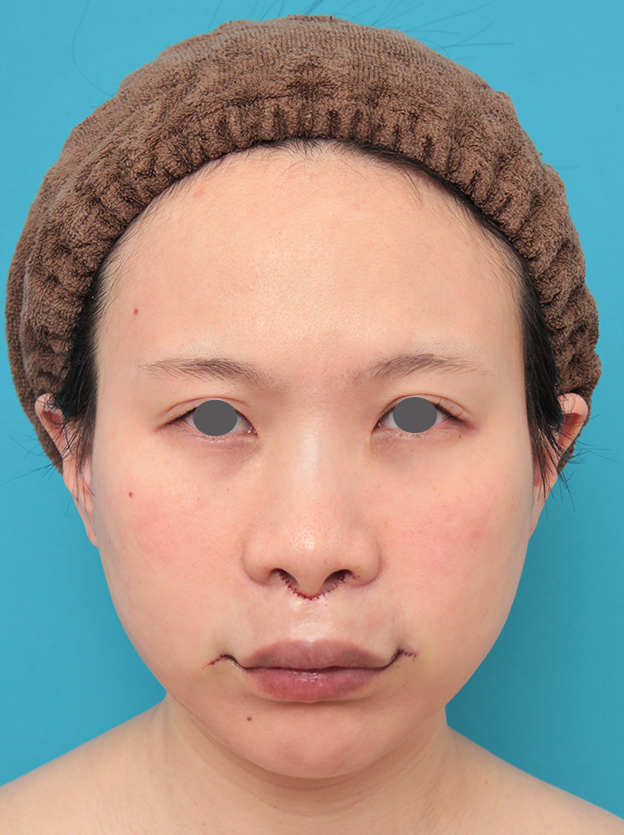 鼻の下を短く（上口唇短縮手術、上口唇リフト、リップリフト、人中短縮術）,人中短縮と口角挙上を同時に行った20代女性の症例写真,手術直後,mainpic_hanashita011b.jpg
