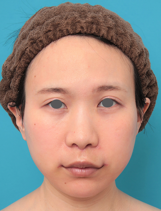 鼻の下を短く（上口唇短縮手術、上口唇リフト、リップリフト、人中短縮術）,人中短縮と口角挙上を同時に行った20代女性の症例写真,6日後,mainpic_hanashita011c.jpg