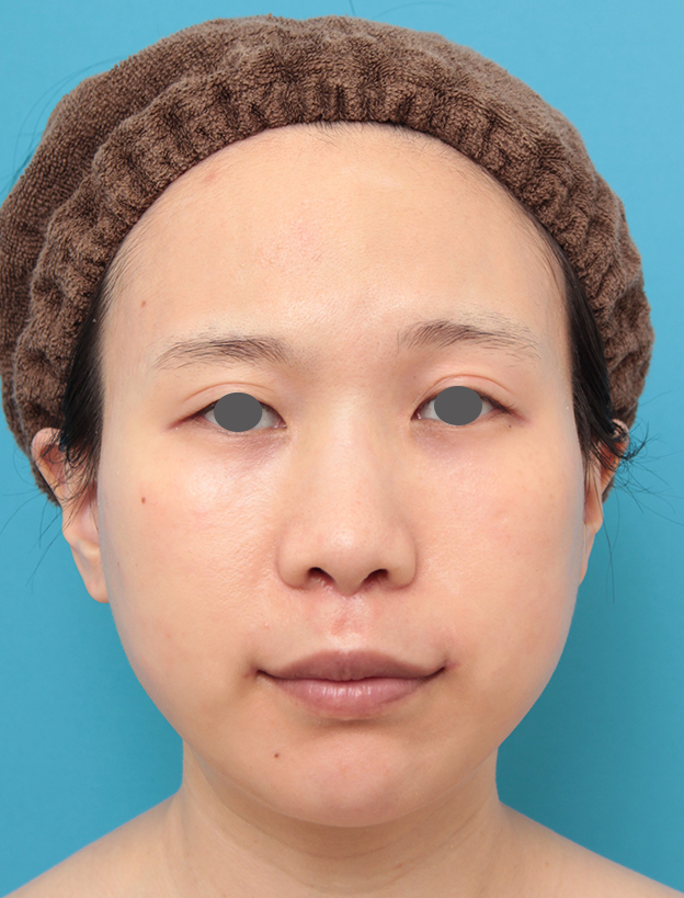 鼻の下を短く（上口唇短縮手術、上口唇リフト、リップリフト、人中短縮術）,人中短縮と口角挙上を同時に行った20代女性の症例写真,3週間後,mainpic_hanashita011d.jpg