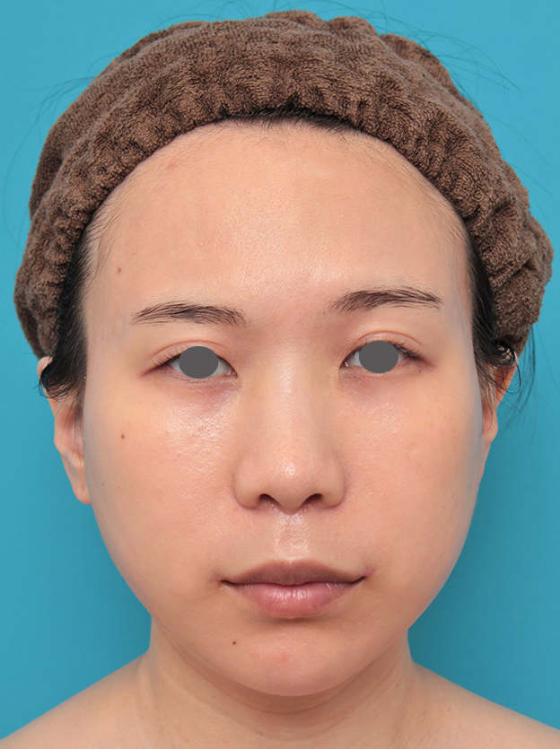 口角拳上術,人中短縮と口角挙上を同時に行った20代女性の症例写真,2ヶ月後,mainpic_hanashita011e.jpg