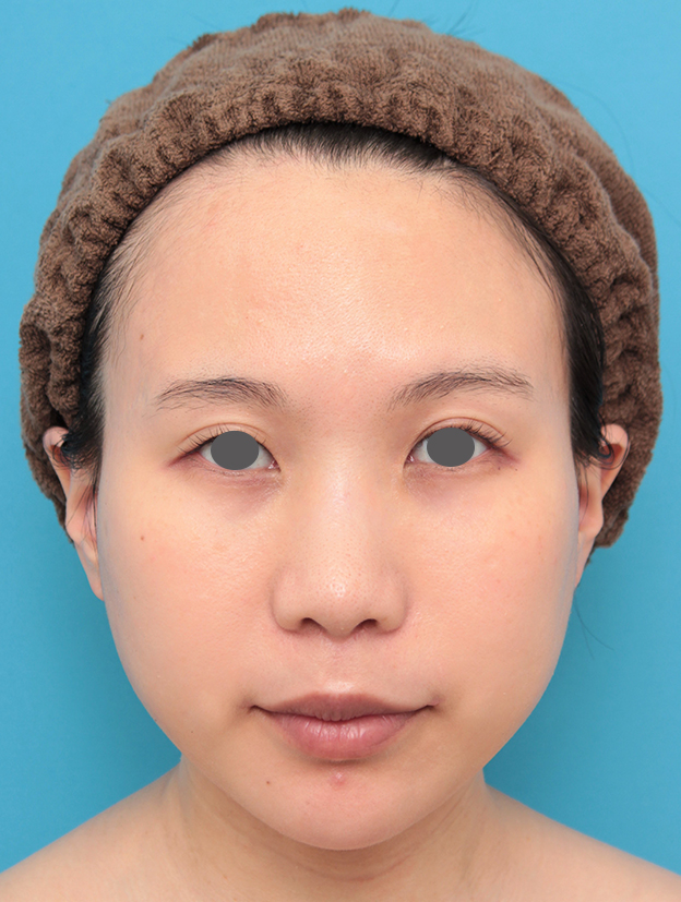 鼻の下を短く（上口唇短縮手術、上口唇リフト、リップリフト、人中短縮術）,人中短縮と口角挙上を同時に行った20代女性の症例写真,6ヶ月後,mainpic_hanashita011f.jpg